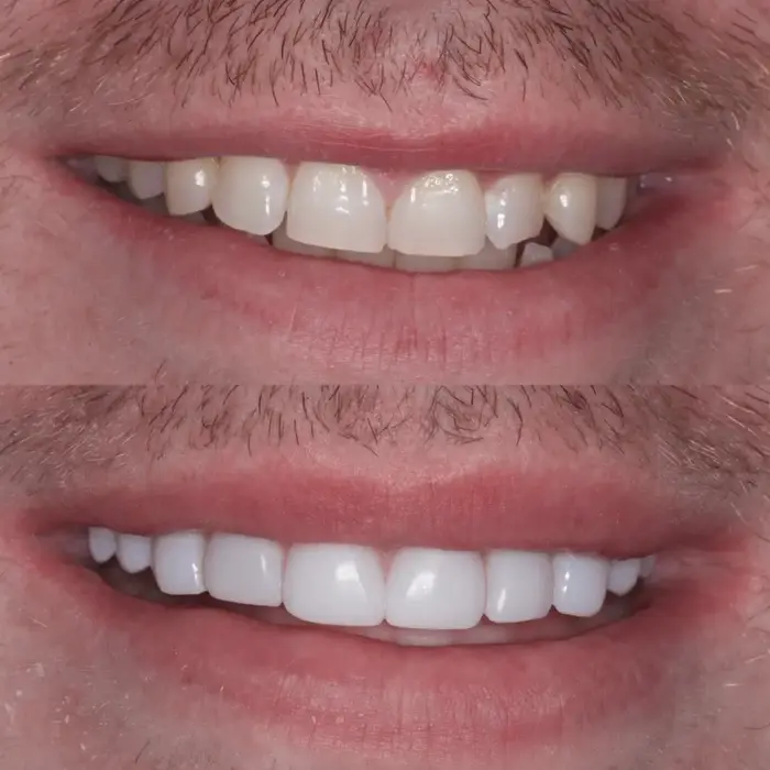 Before and after 10 upper teeth with composite bonding