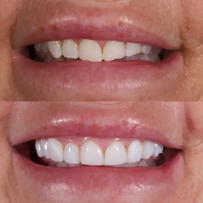 Before and after composite bonding on 10 teeth