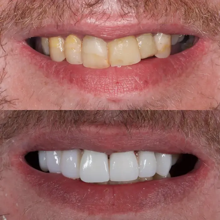 Before and after 4 zirconia crowns and composite bonding on 3 teeth