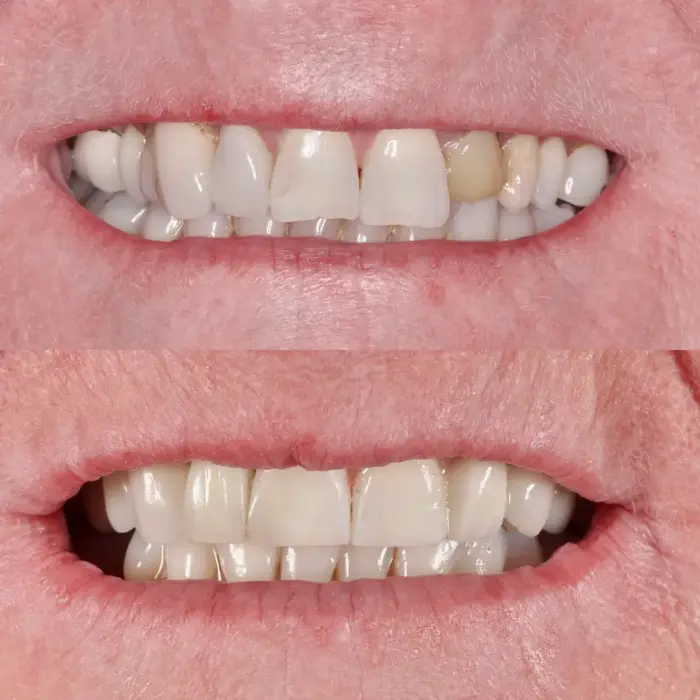 Before and after E.max veneers and crowns with one composite bonded tooth