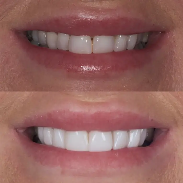 Before and after composite bonding on 10 teeth