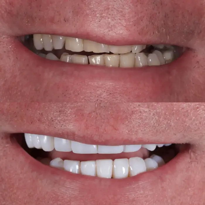 Before and after composite bonding on 19 teeth and one bridge