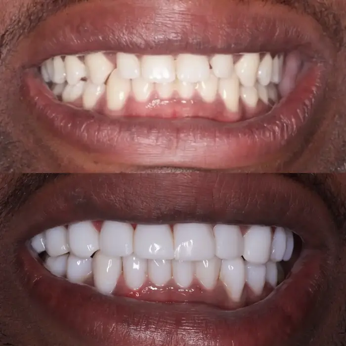 Before and after composite bonding on 20 teeth