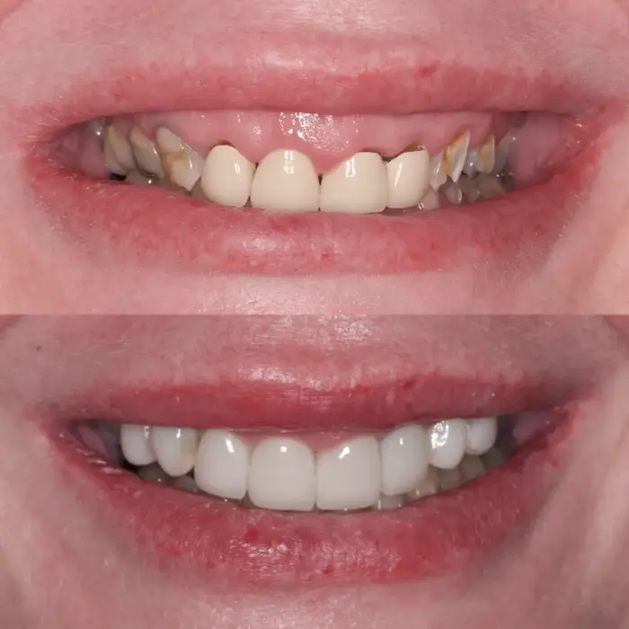 Before and after composite bonding on 4 teeth and 4 E.max crowns