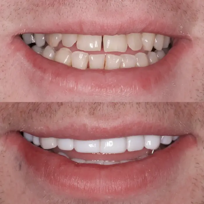 Before and after composite bonding on 20 teeth