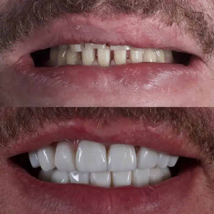 Before and after 18 veneers